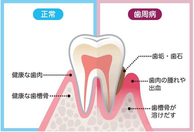 歯周病ってどんな病気？