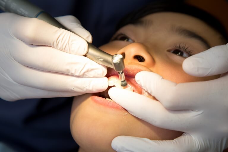 歯のクリーニング（PMTC：Professional Mecanical Tooth Cleaning）