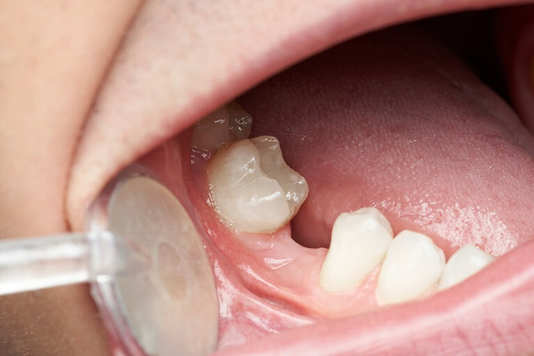 歯を抜歯した後の3つの治療