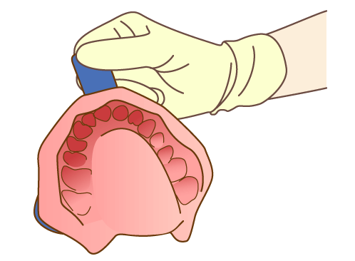 インビザライン用の歯型を採取